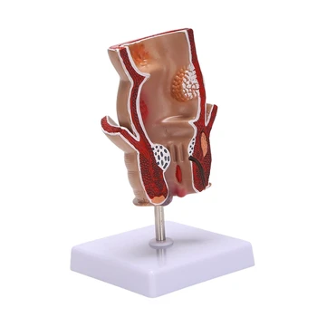 Анатомическая модель Поражения прямой кишки геморроем человека Модель обучения патологии Геморроидальных свищей и фистульной трещины
